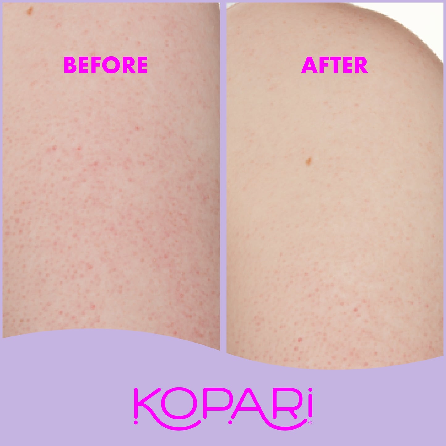 KP Body Bumps Be Gone Exfoliating Body Scrub